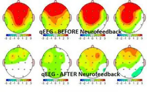 What Is Neurofeedback Therapy
